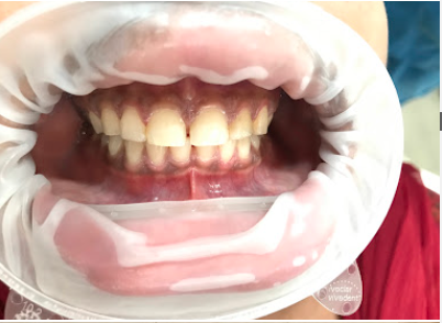 Restored Natural Smile After Treatment