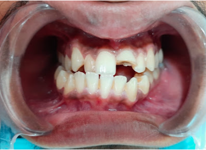 Tooth Fracture Before Clinical Treatment